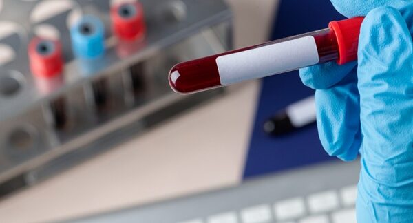 Departamentos de hematología - Hematólogo sosteniendo un tubo de ensayo clínico para diagnosticar enfermedad de la sangre en uno de los mejores departamentos de hematología de Valencia