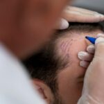 Tricólogos - Médico capilar realizando el boceto del trasplante de cabello reconocido como uno de los mejores tricólogos en Valencia