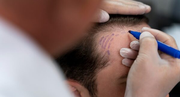 Tricólogos - Médico capilar realizando el boceto del trasplante de cabello reconocido como uno de los mejores tricólogos en Valencia