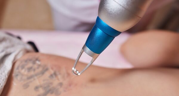 Centros de eliminación de tatuajes - Proceso para eliminar tatuajes láser en uno de los mejores centros de eliminación de tatuajes en Valencia
